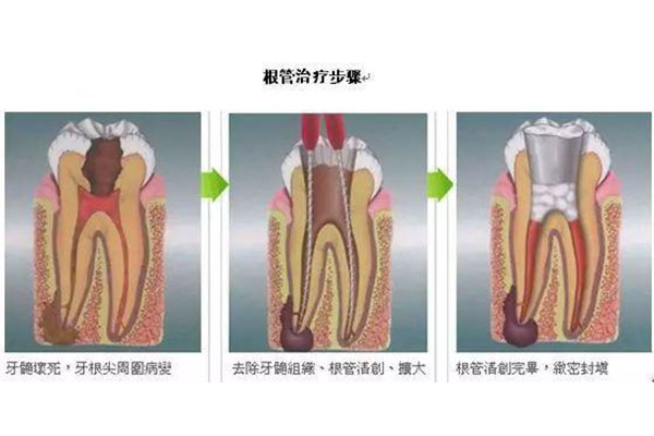 4岁小孩有必要做根管治疗吗多少钱