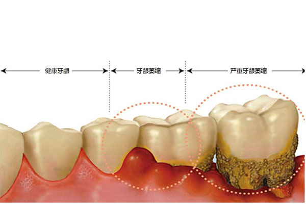 38岁牙龈萎缩可以恢复正常吗为什么