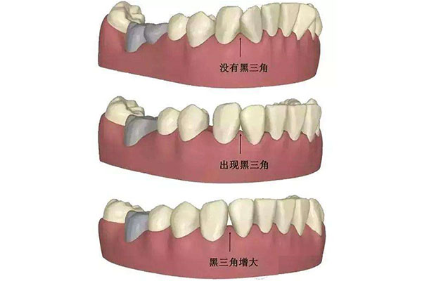 30多岁牙龈萎缩(30多岁牙龈萎缩能治愈