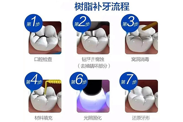 3m树脂补牙能维持多久寿命(3m树脂补牙