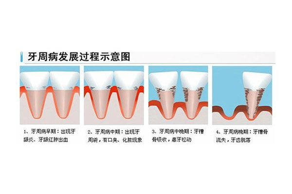 中医治疗牙周炎的秘方有哪些呢(中医