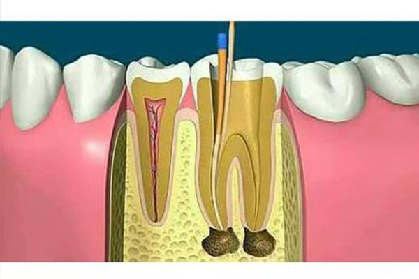 一颗牙可以做几次根管治疗手术(一颗牙齿能做几次根管治疗?)