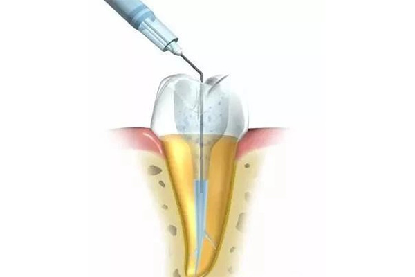 一般根管治疗费用大概多少钱(一般根