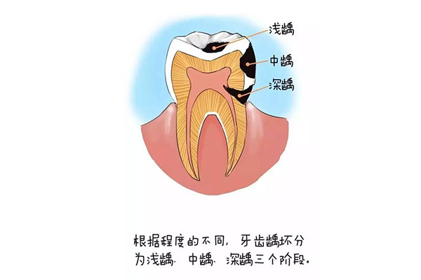 22岁蛀牙超级严重怎么办呀(22岁蛀牙超级严重怎么办呀怎么治疗