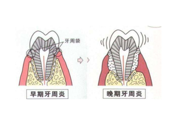 严重牙周炎是什么样的病毒感染(严重牙周炎是什么样的病毒感染