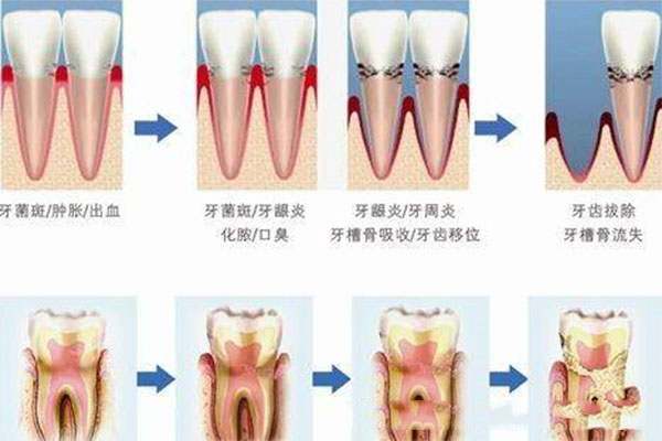 严重牙周炎治疗周期多久(严重牙周炎治疗周期多久正常)