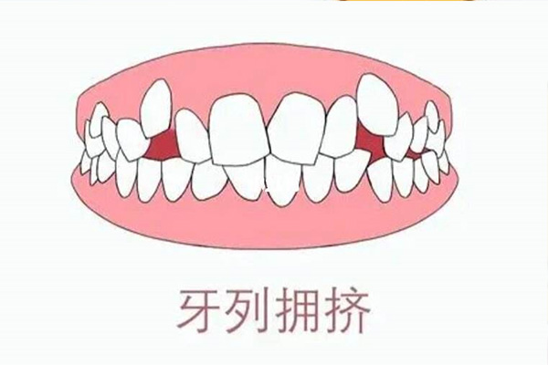 小孩子牙齿拥挤怎么办(小孩子牙齿拥