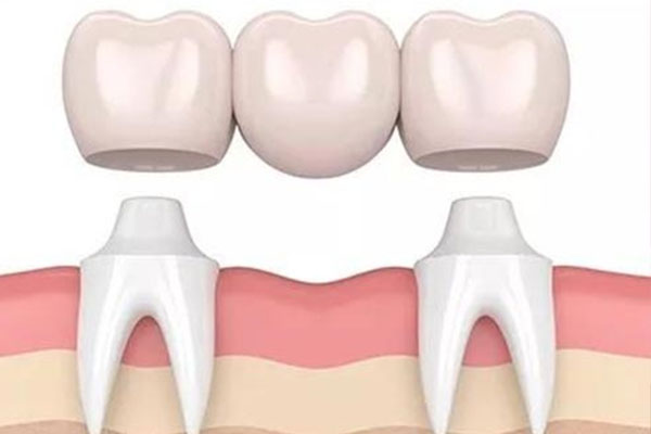 3d烤瓷牙和普通烤瓷牙有什么区别(3