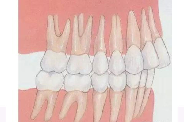 21岁地包天能矫正吗(21岁地包天牙齿矫