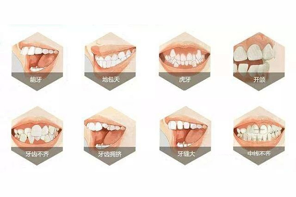 32岁龅牙(32岁龅牙矫正可以改善凸嘴吗