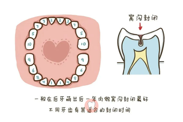 8岁儿童窝沟封闭一般做几颗牙齿正常