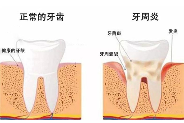 严重牙周炎对身体有害吗女性(严重牙