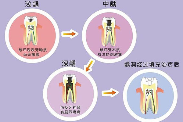 22岁长虫牙了怎么办(22岁长虫牙了怎么