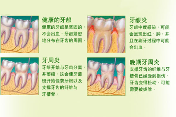 中医治牙周炎多久能好(中医治牙周炎