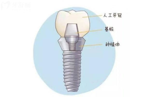 60岁掉牙齿是什么预兆现实种牙(60岁的