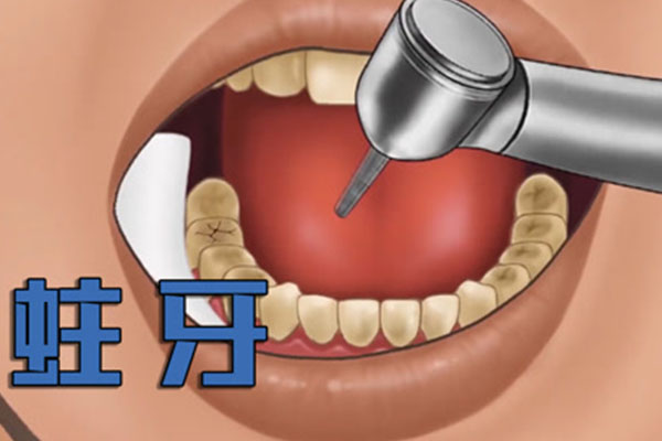 20岁牙齿蛀牙严重吗(20岁牙齿蛀牙严重