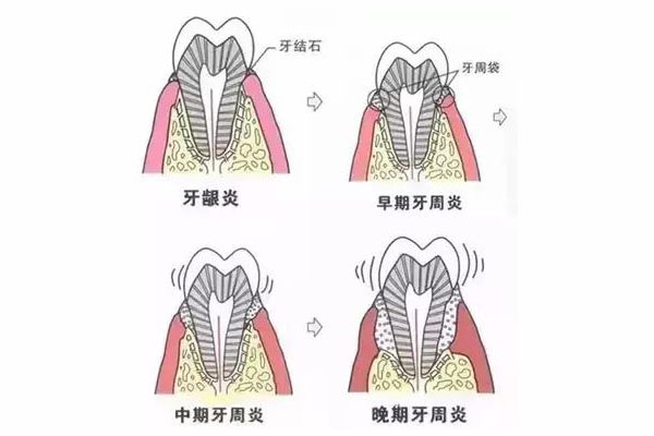 严重的牙周炎如何治疗牙疼,用啥牙膏比较好(严重的牙周炎如何