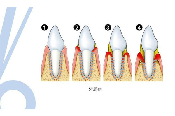 2岁牙周炎是什么引起的(2岁孩子牙周炎怎么办)