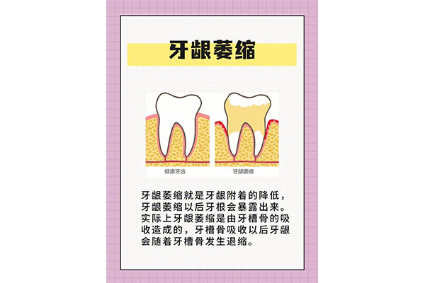 30多岁牙龈萎缩怎么回事啊(30多岁牙龈