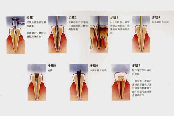 3m树脂补牙z250(3m树脂补牙z250和z350的区别)