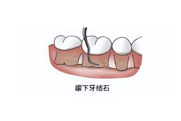 俩周岁宝宝牙齿有点钙化了怎么办啊