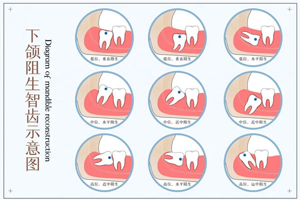 上排最后一颗牙齿是智齿吗(上排最后