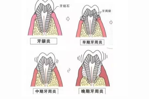 严重的牙周炎能治好吗多少钱一次(严