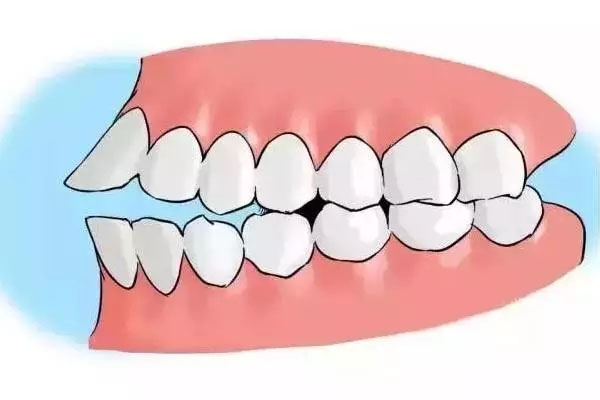 17岁地包天戴牙套还能矫正吗(17岁地包