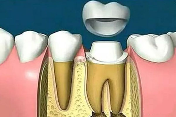 3M流体树脂和固体树脂补牙的区别(3m流体树脂补牙价格)