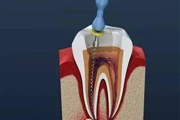 一颗牙根管治疗多长时间(一颗牙根管治疗多长时间完成)