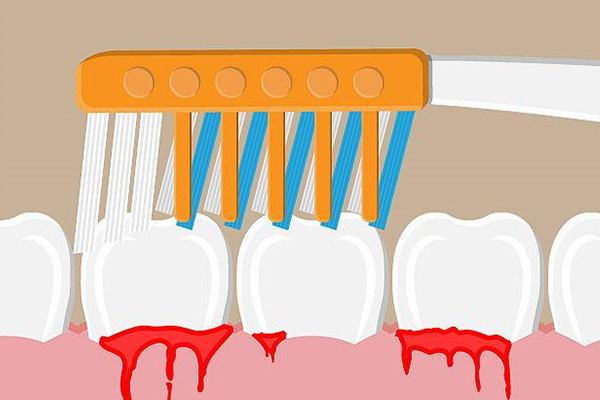 20岁青年牙龈出血是什么原因(20岁青年牙龈出血是什么原因引起
