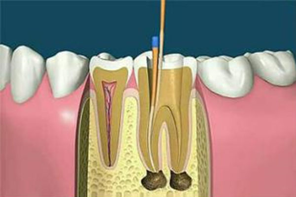 一次性根充和根管治疗的区别(根管好