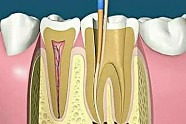 一般一颗牙根管治疗多少钱(一般一颗牙根管治疗多少钱左右)