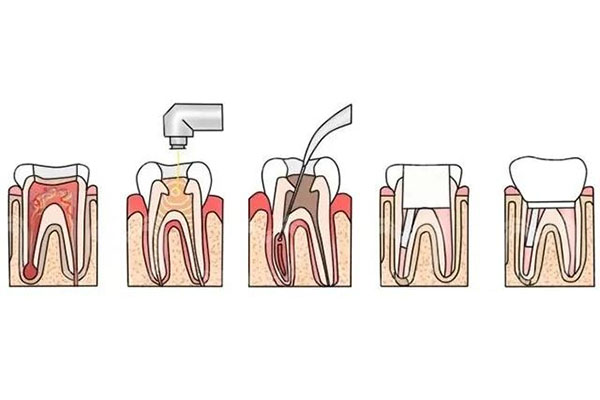 5岁做根管治疗的危害(5岁孩子做根管治疗有风险吗)