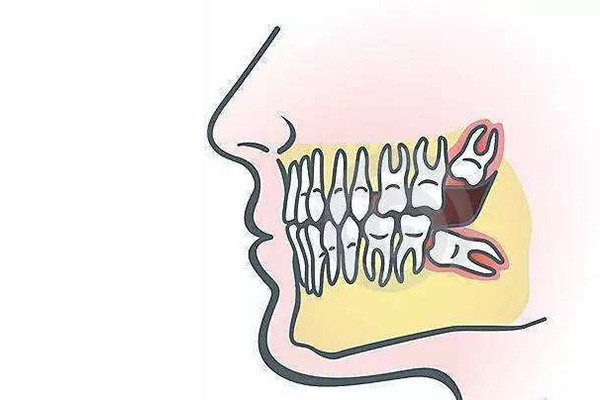 一般第几颗牙是智齿的(一般第几颗牙是智齿的图片)
