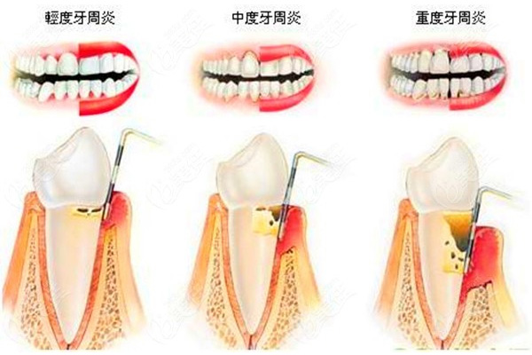 严重牙周炎怎么治疗效果好呢(严重牙