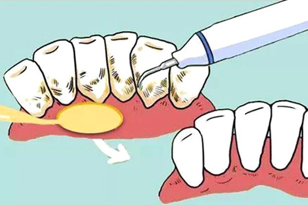 一定要洗牙结石吗(一定要洗牙结石吗图片)