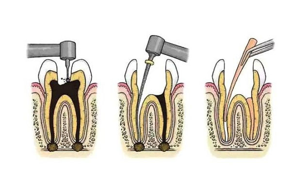 一个牙齿做根管治疗大概多少钱左右(一个牙齿做根管治疗需要多