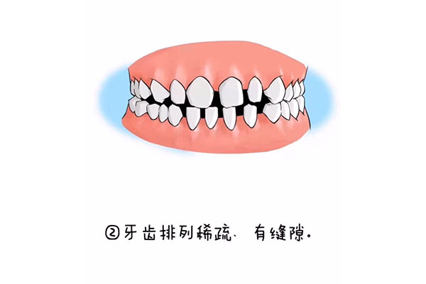 牙齿稀疏牙缝大可以带牙套吗多少钱