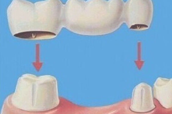 什么叫固定义齿镶牙(什么叫固定义齿镶牙手术)
