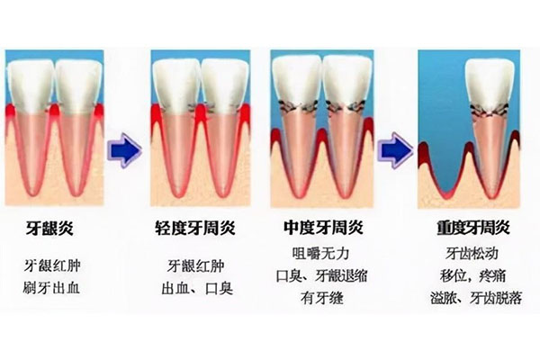 中医如何解释牙周炎的原因(中医如何解释牙周炎的原因和治疗