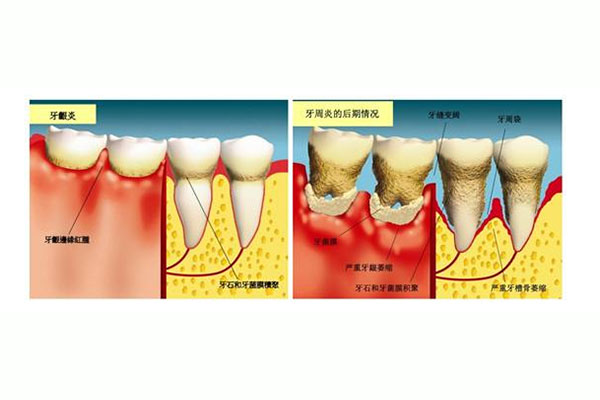 中医 牙周炎治疗(中医 牙周炎治疗方