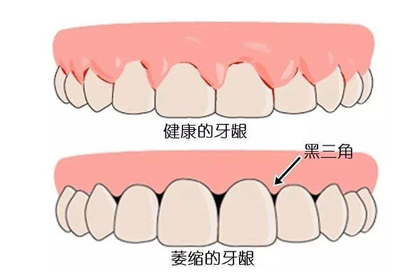 33岁牙龈萎缩严重吗为什么(33岁牙龈萎