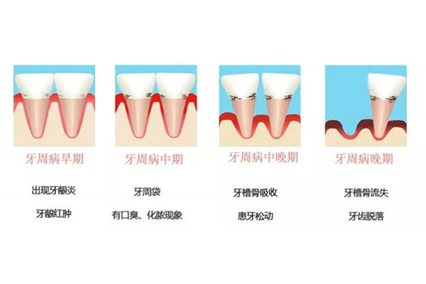 严重牙周炎是什么样的女性症状(严重