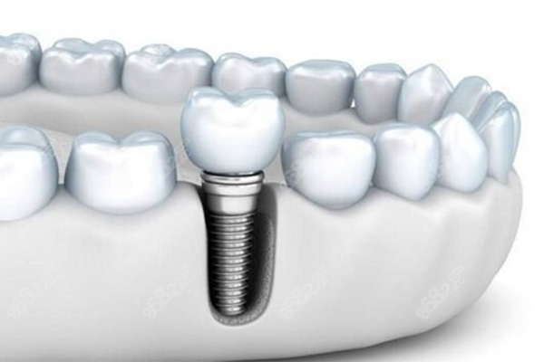 2024年种牙纳入医保了吗(良心医生不建议种植牙的缘由)