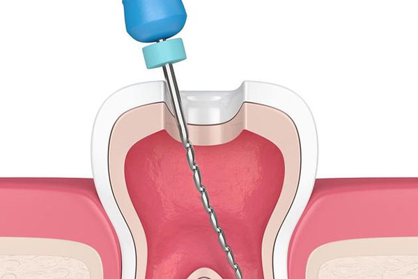 7号牙根管治疗还用拔智齿吗(7号牙根管治疗还用拔智齿吗视频