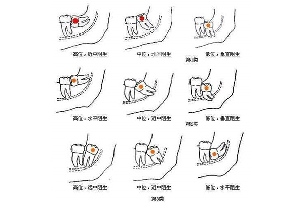 三甲医院拔智齿可以用医保吗报销吗多少(三甲医院拔智齿可以用