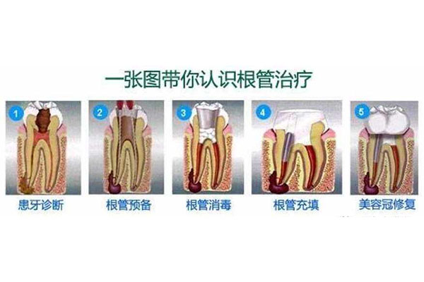 4岁有必要做根管治疗吗多少钱一颗牙(4岁有必要做根管治疗吗多