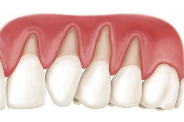 20多岁牙龈萎缩正常吗(20多岁牙龈萎缩