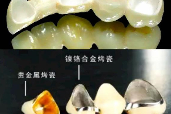 一颗陶瓷牙套可以用多久(一颗陶瓷牙